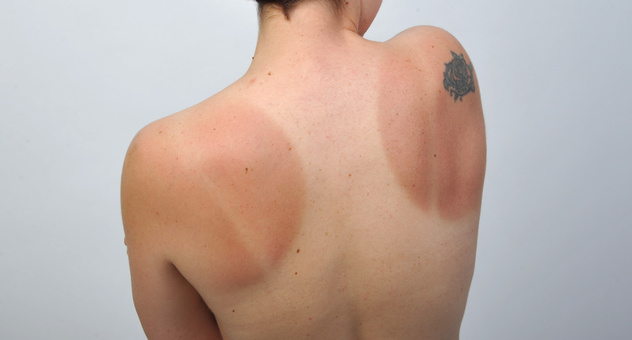 Frau von hinten mit teilweise Sonnenbrand, teilweise hell gebliebener Haut in Form eines Shirts