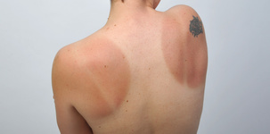Frau von hinten mit teilweise Sonnenbrand, teilweise hell gebliebener Haut in Form eines Shirts